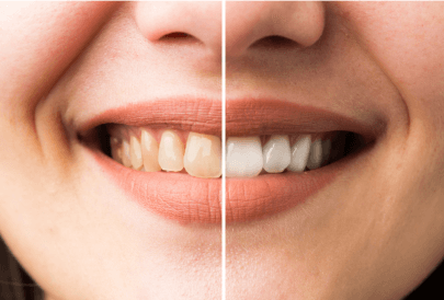 odontologia estética dentes mais alinhados e brancos sem carie