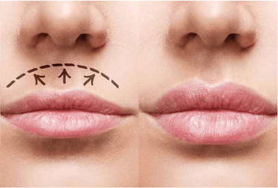 preenchimento labial labios volumososantes e depois